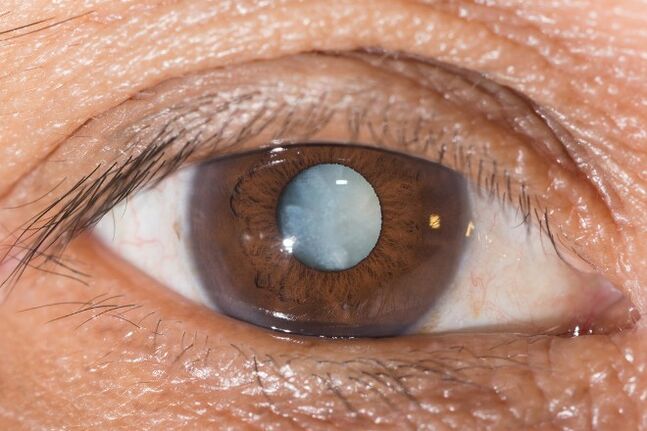 With cataracts, exercises to improve vision are indicated.