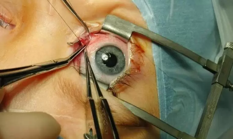 Performing eye surgery using an eyelid speculum